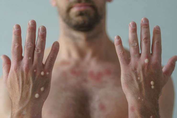 Imagem: As lesões formadas no corpo do paciente assemelham-se as de catapora